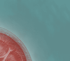 End Stage Renal Disease